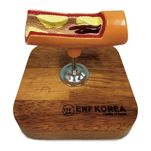 Artery with Thrombus Model