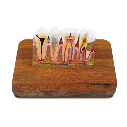 Dental Pulp Disease Model