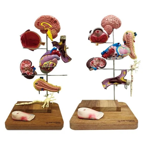[EC32] Diabetes Model