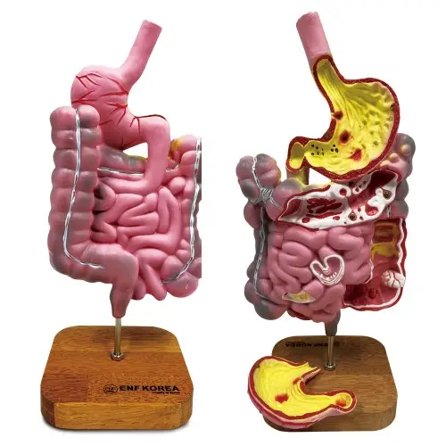 [ED13] Diseased Digestive System Model