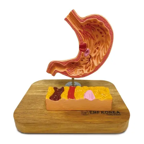 [ED21B] Stomach model with ulcer