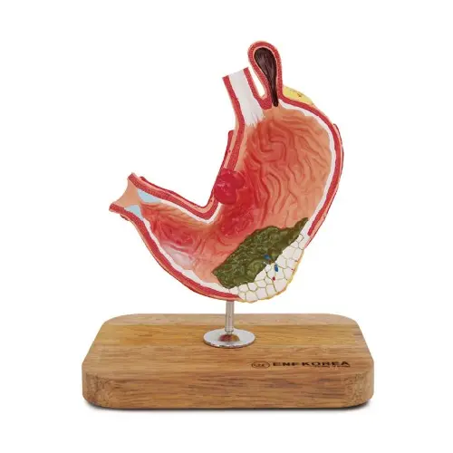 [ED21G] Stomach Cancer model