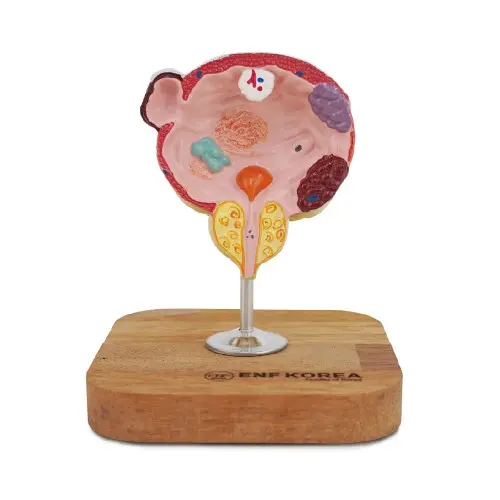 [EU34] Diseased Bladder and Prostate Model