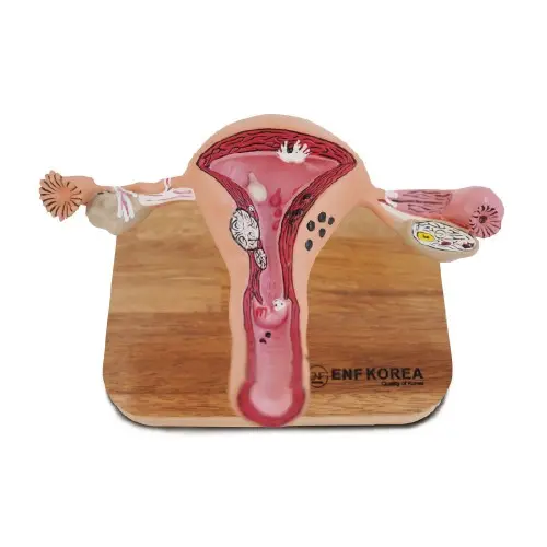 [EU43B] Uterus Disease Model